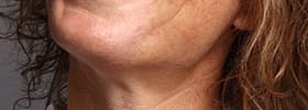 Pérdida de firmeza en cuello