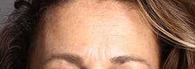 Signos de edad en la frente